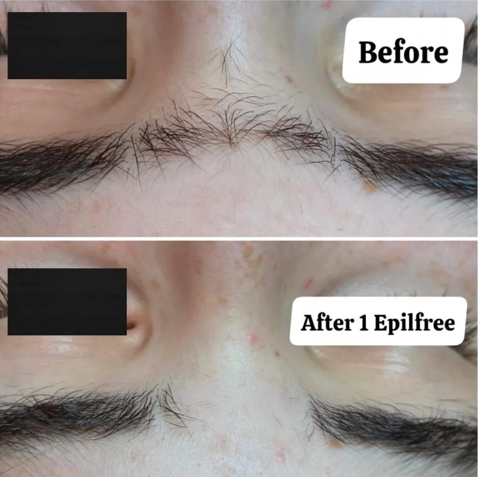 Visible Hair Reduction After 1 Epilfree Treatment