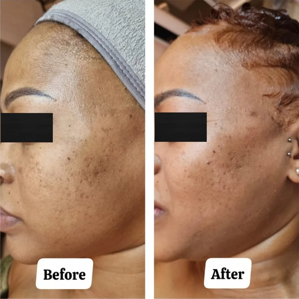 Microneedling Skin Rejuvenation