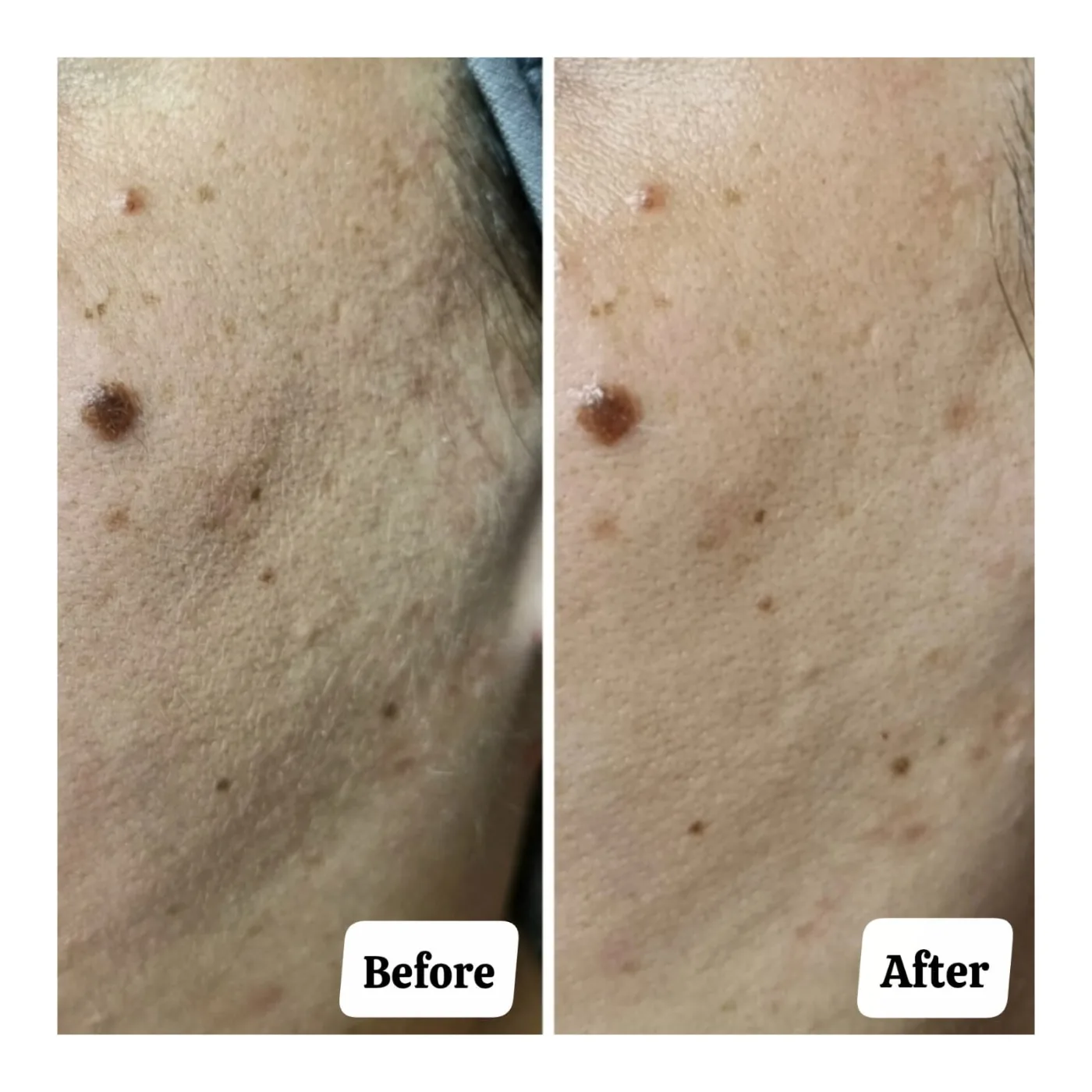 Dermaplaning Ultimate Glow