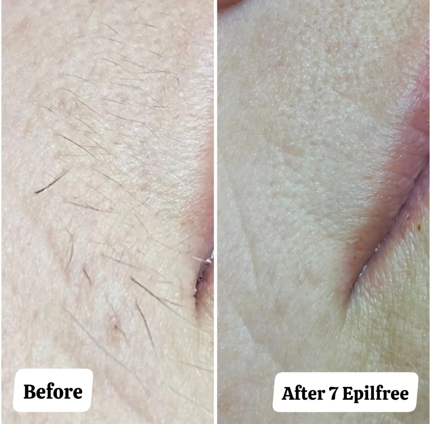 Visible Hair Reduction with Epilfree