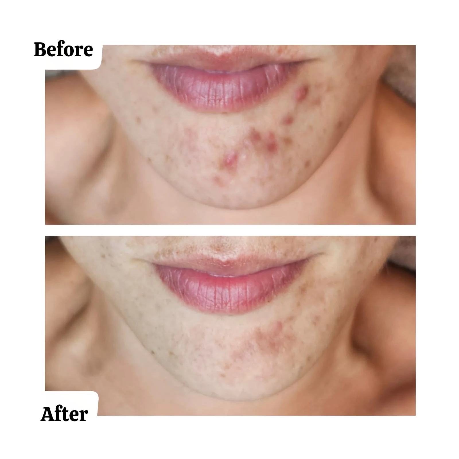 Client skin result following a consultation-led treatment plan