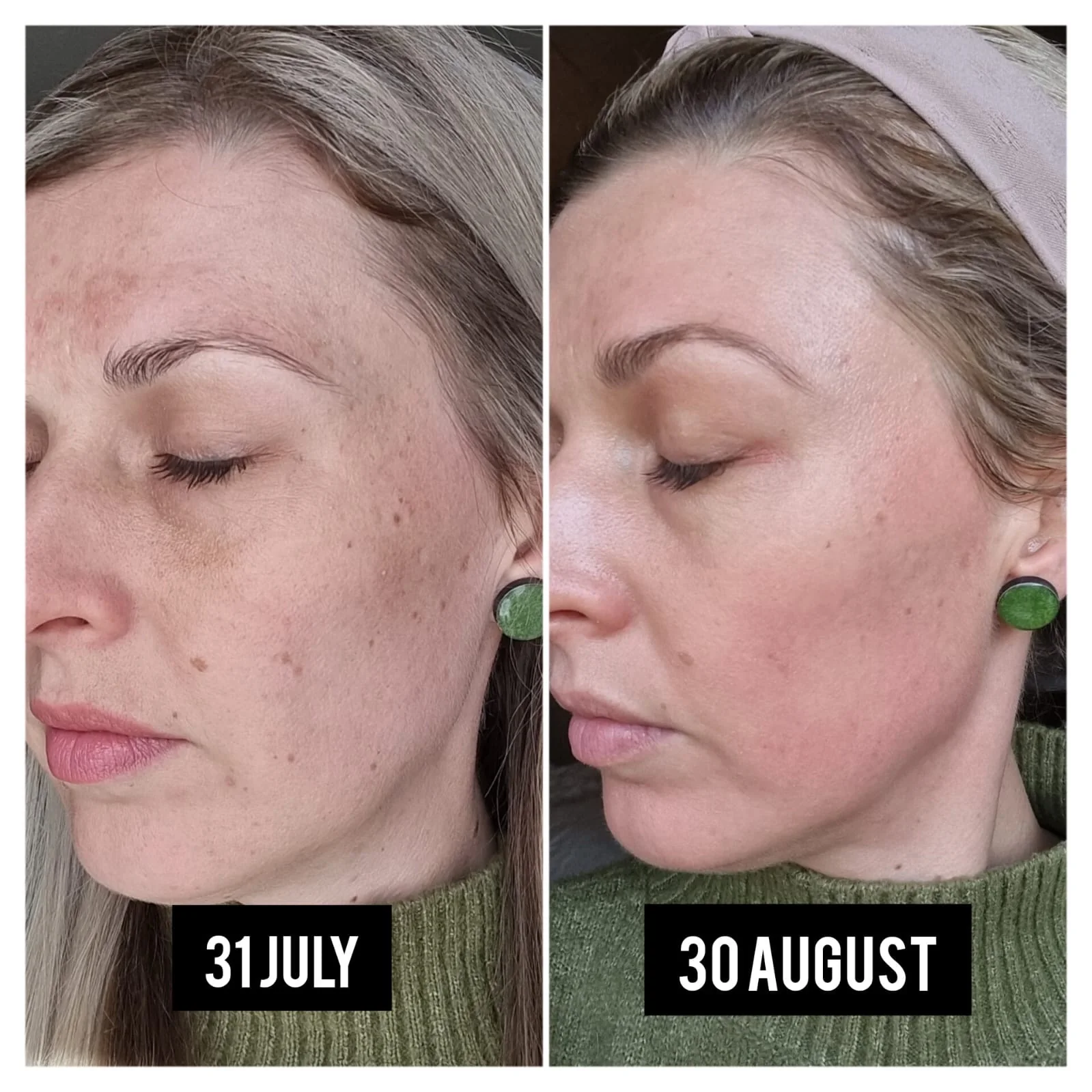 Cosmelan pigmentation treatment before and after result