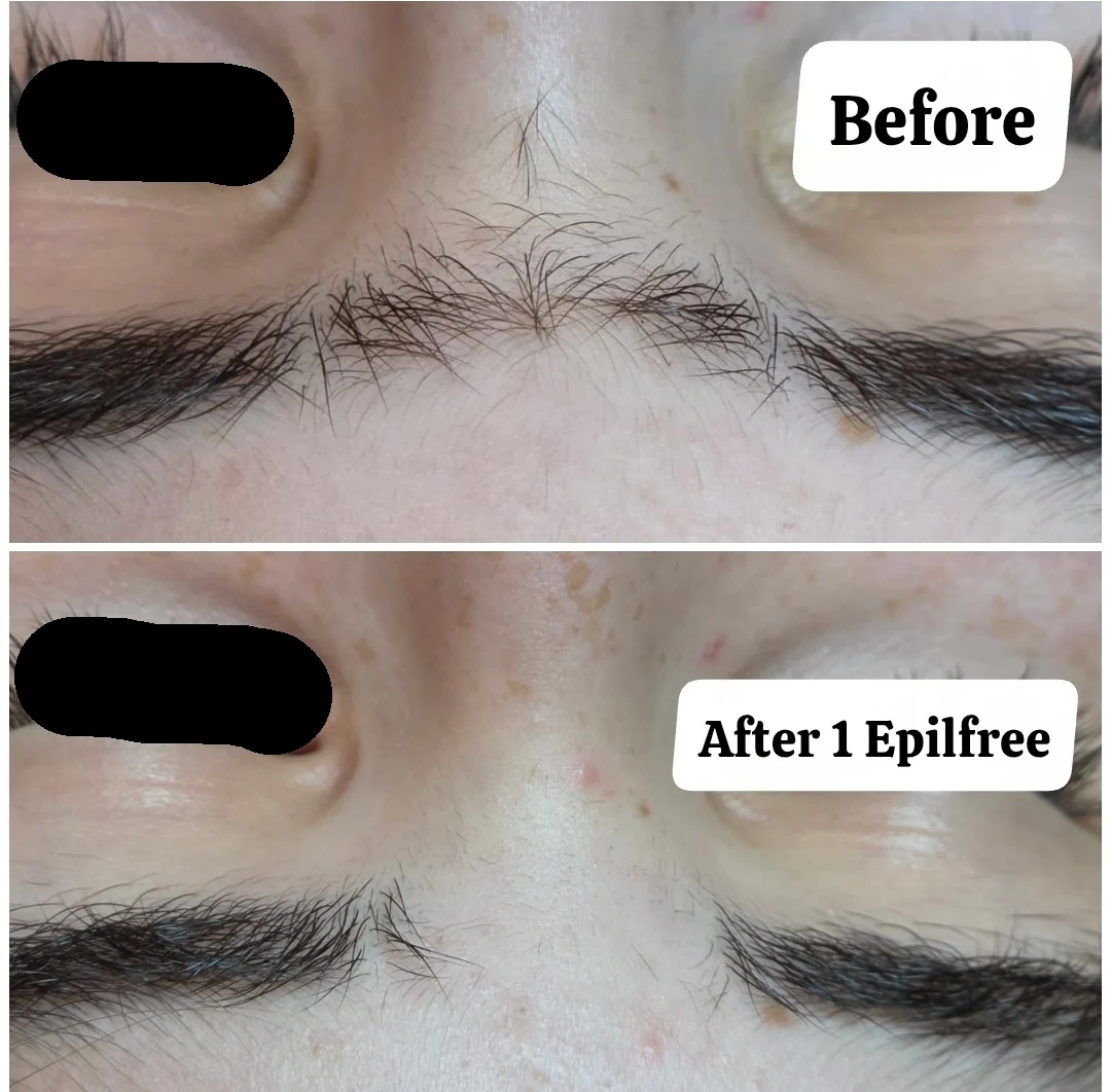 Epilfree hair removal before and after result