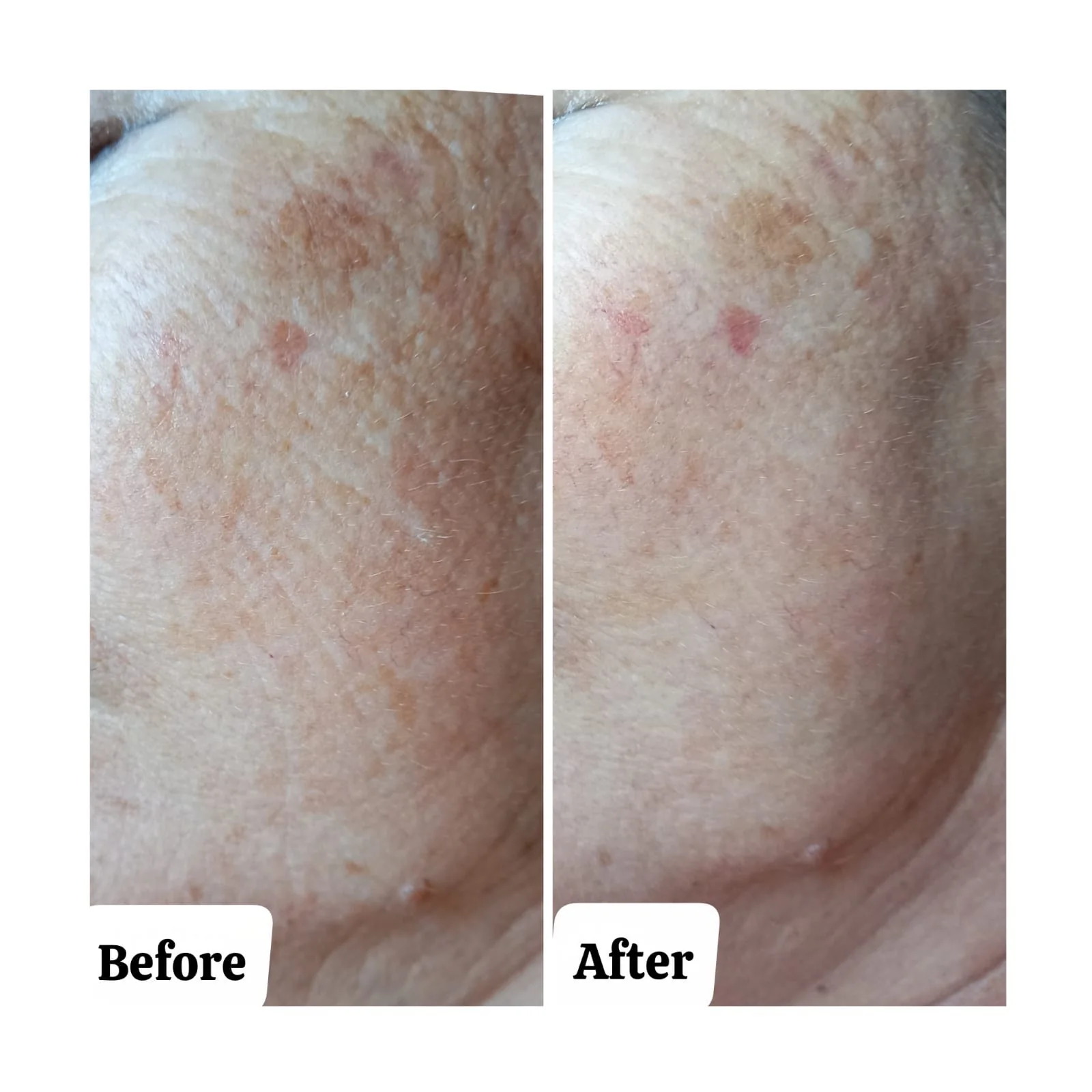 Microneedling – Skin Rejuvenation